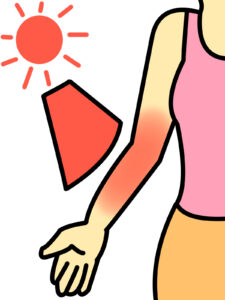 サンバーンのイラスト