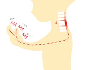 寝違えの症状のイラスト