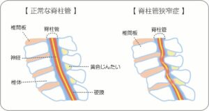 坐骨神経痛