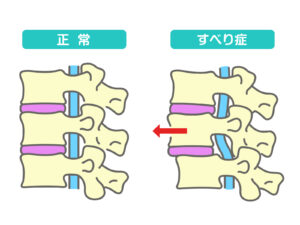 坐骨神経痛